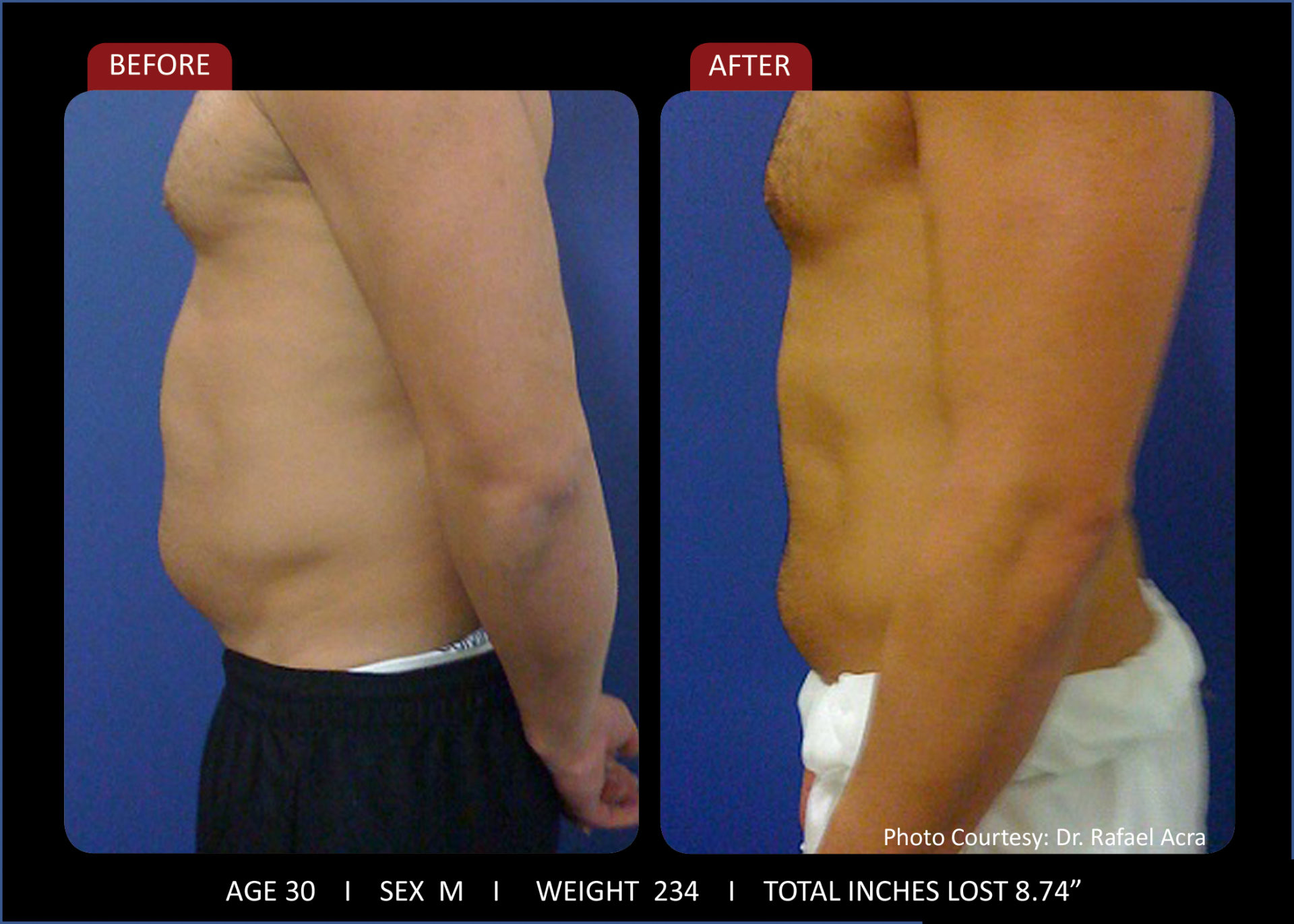 Before and after photo laser weight loss man side view
