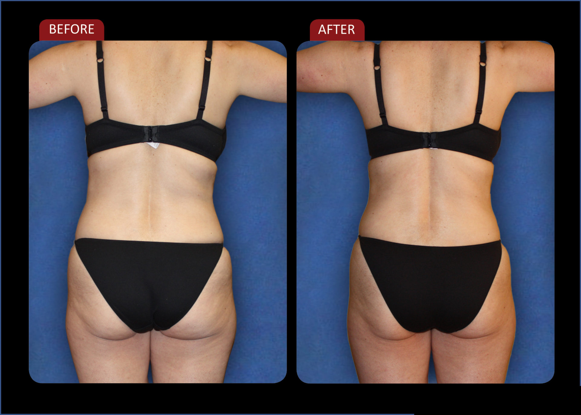 Before and after photo weight loss treatment woman back view