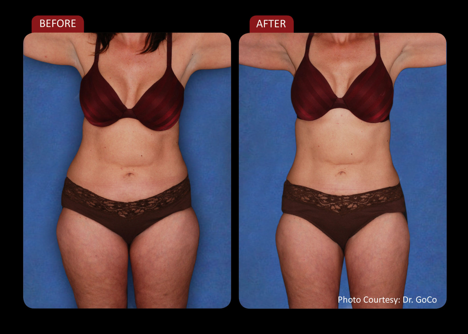 Before and after photo laser weight loss woman front view