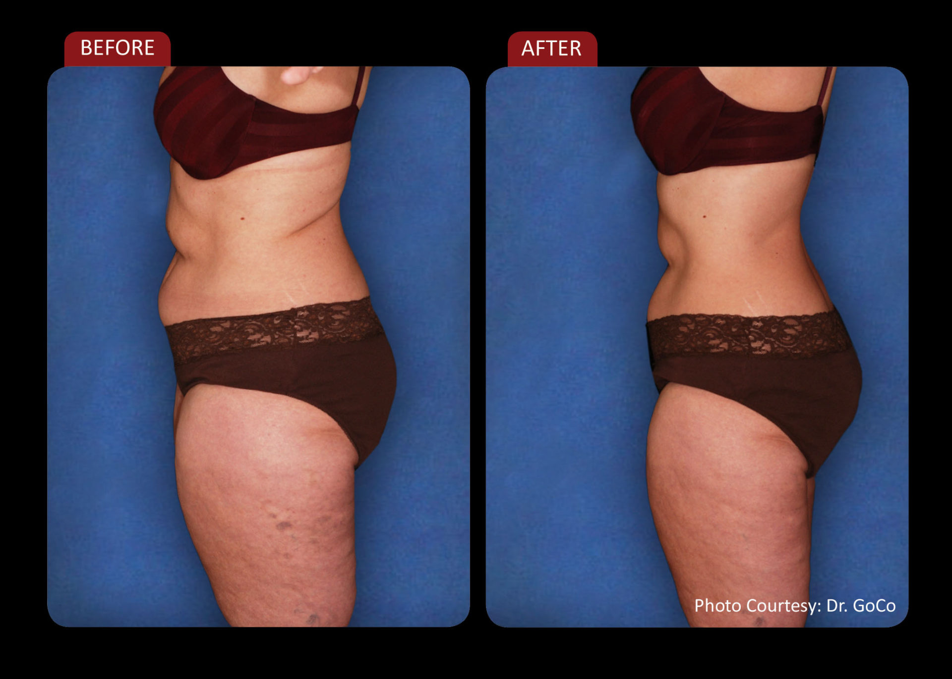 before and after photo laser weight loss woman side view