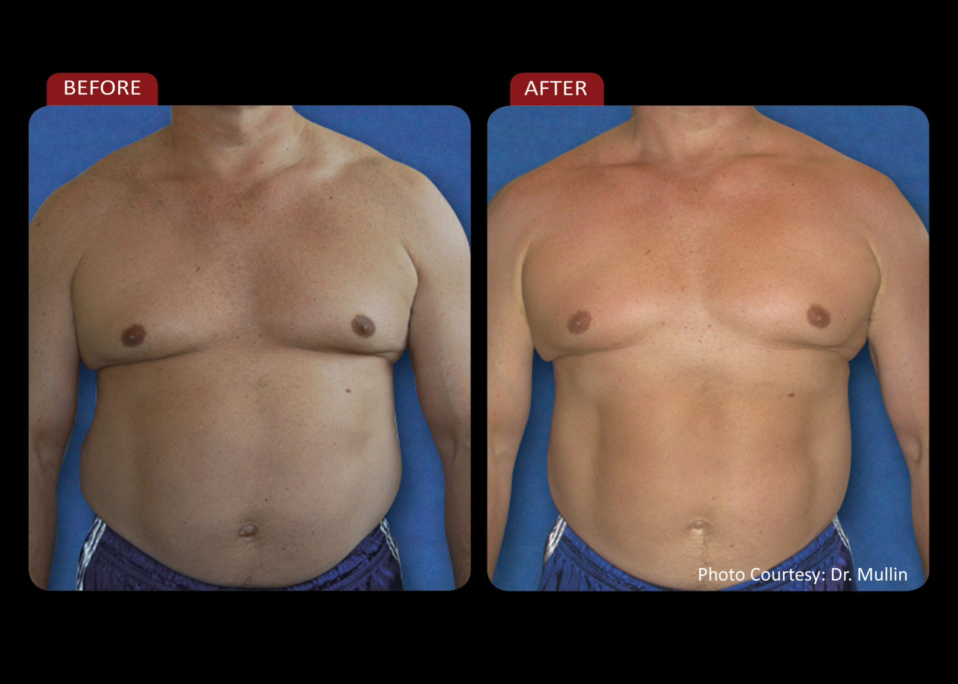 Before and after photo laser weight loss man front view